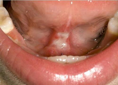 成人剪舌根过程图解视频,成人剪舌根手术过程图解解析